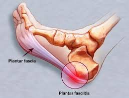 Fascite plantare… un fastidioso problema da evitare